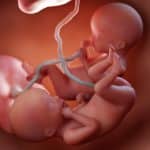 La réduction embryonnaire : Comprendre cette décision difficile